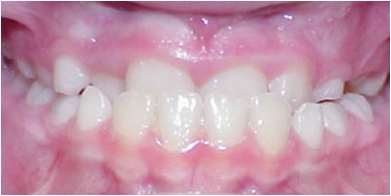 Preventative Orthodontics - Correction of Underbite with Facemask - Case 4