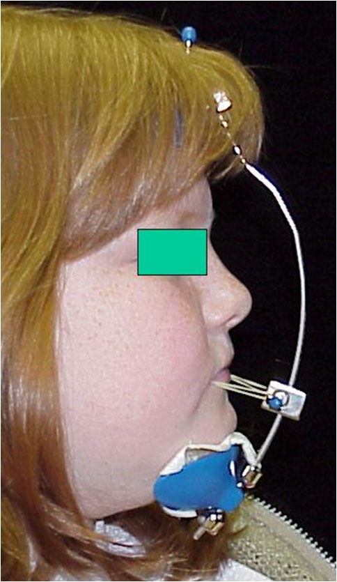 Preventative Orthodontics - Correction of Underbite with Facemask - Case 4