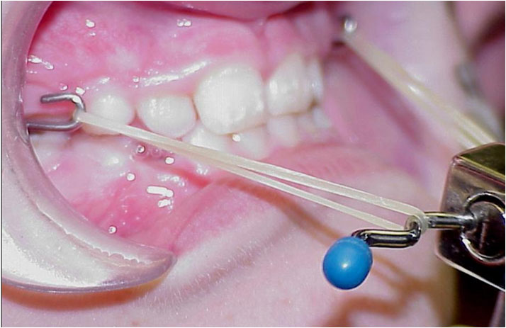 Preventative Orthodontics - Correction of Underbite with Facemask - Case 4
