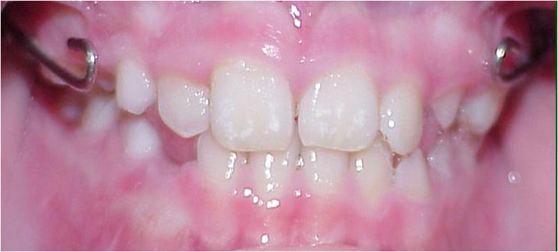 Preventative Orthodontics - Correction of Underbite with Facemask - Case 4