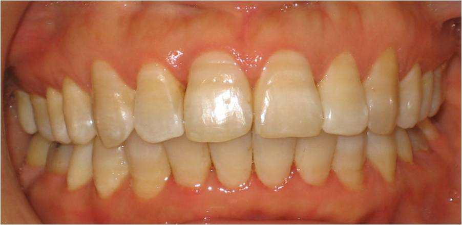 SureSmile - Case 29